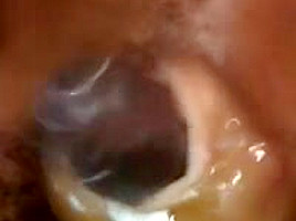 Indiangyal ENT post cum torture